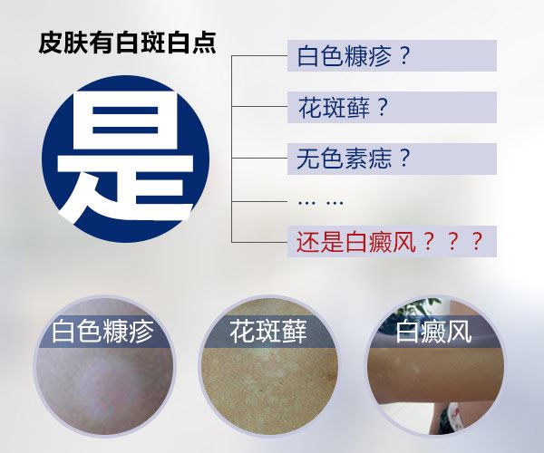 白癜风发病的症状有哪些